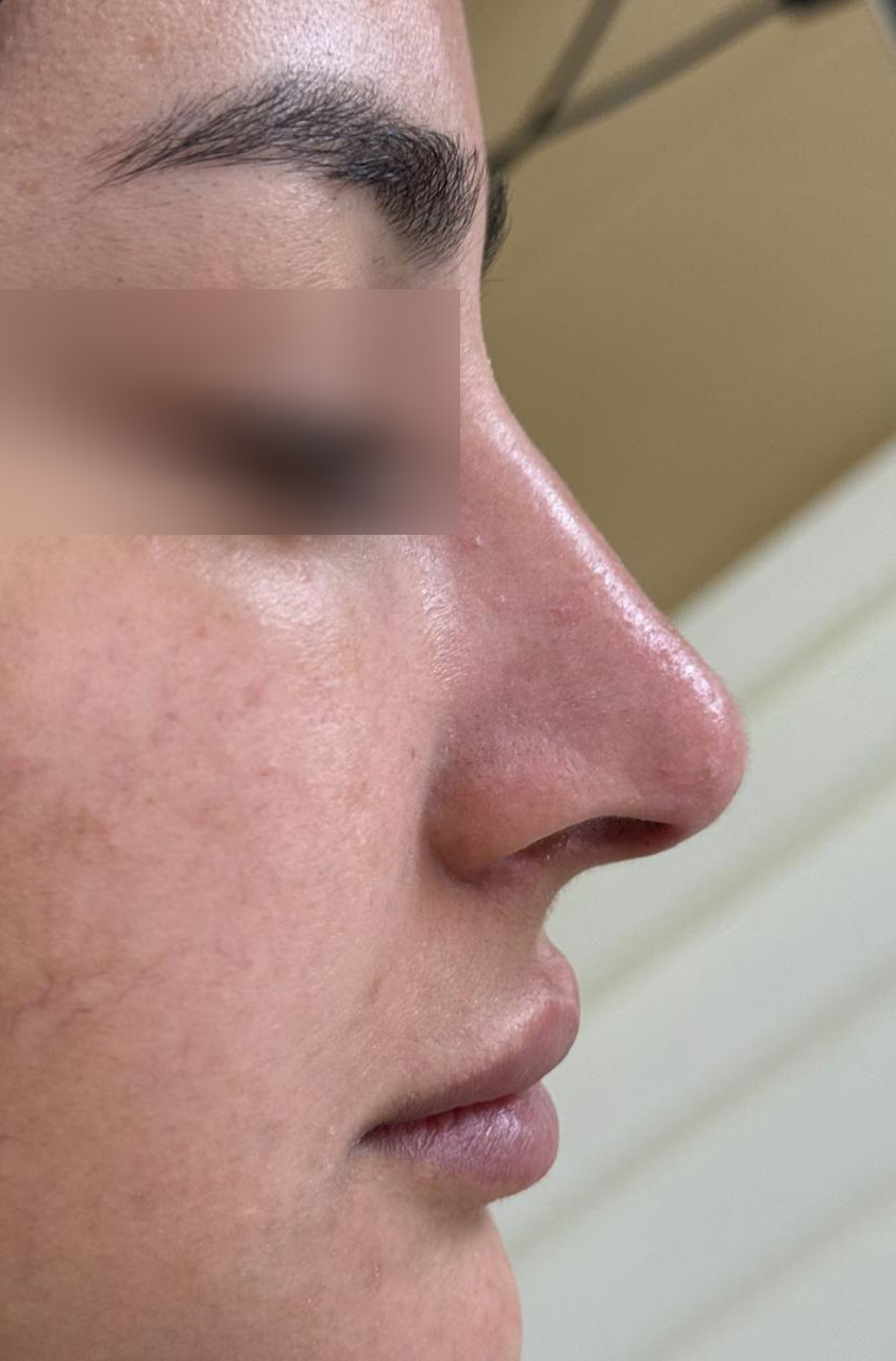 After Rhinoplasty