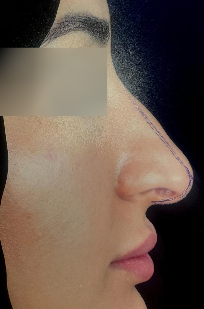 Before Rhinoplasty